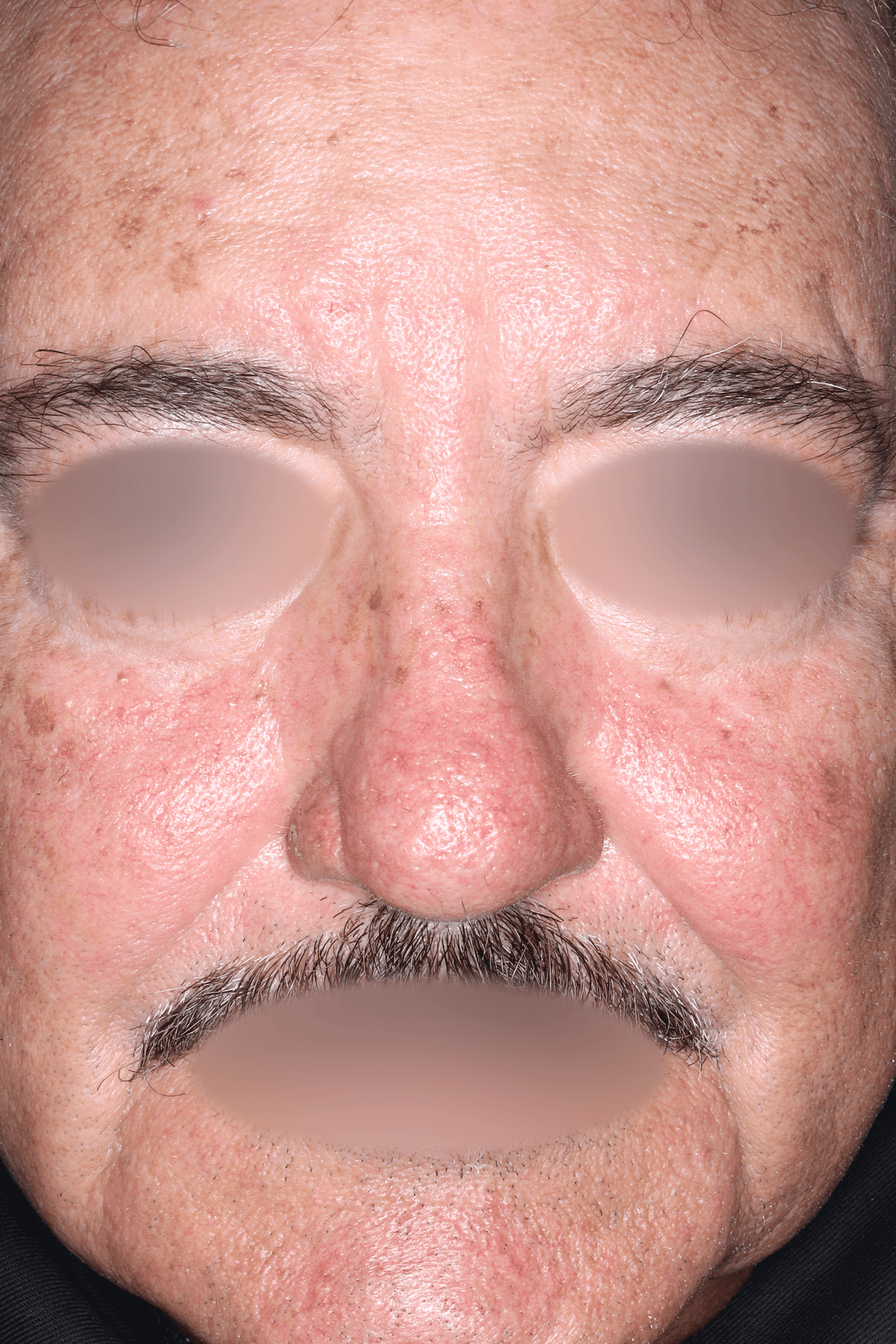 Patient A After