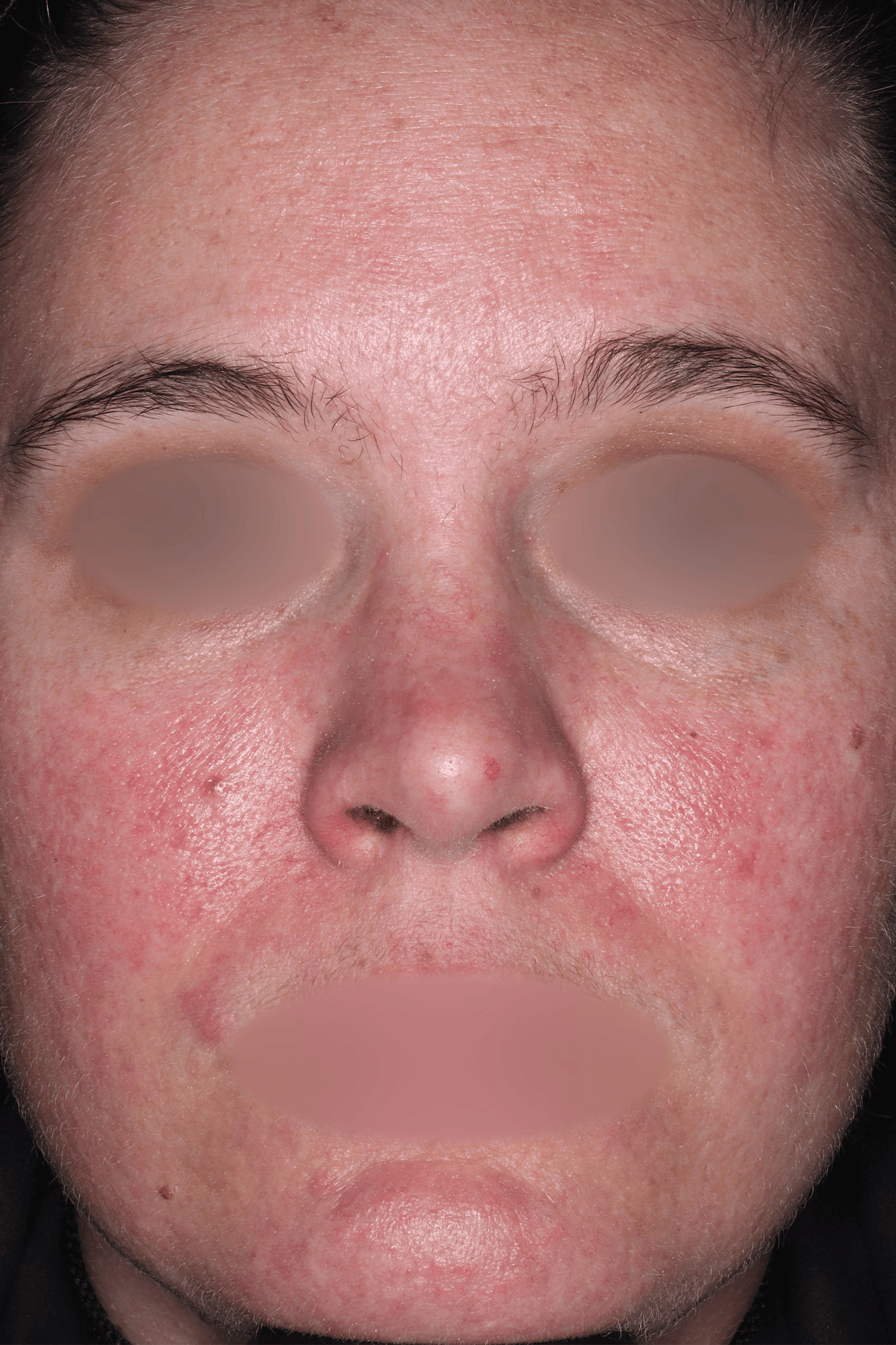 Patient B After