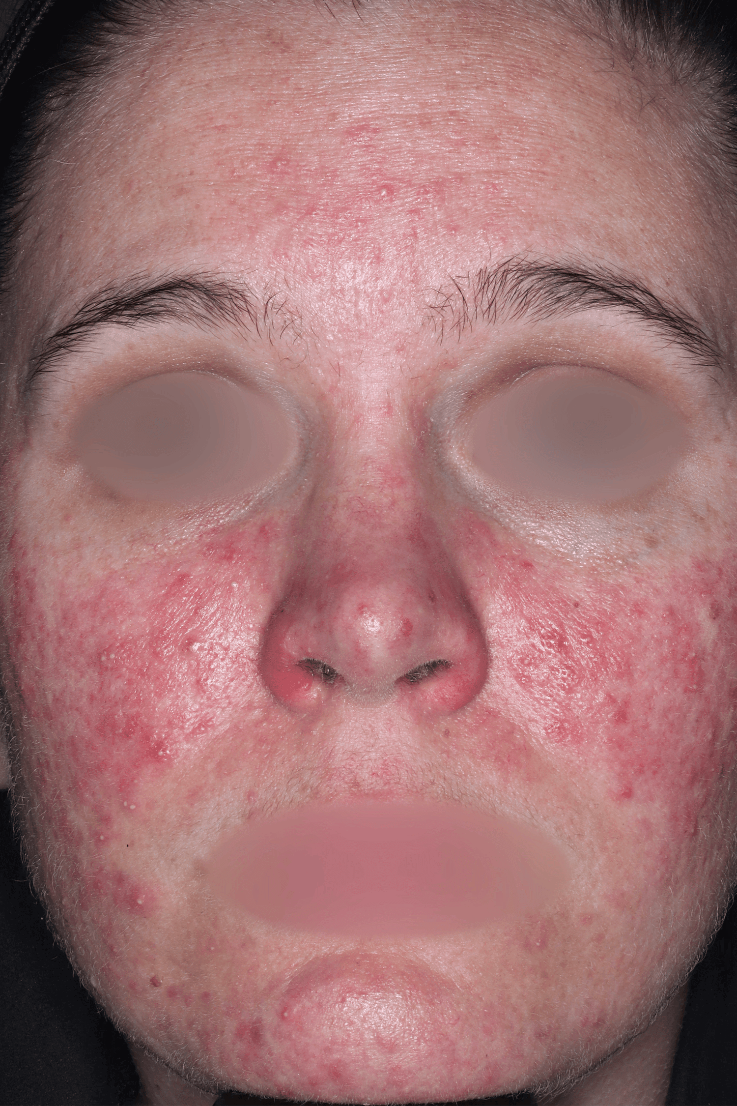 Patient B Before