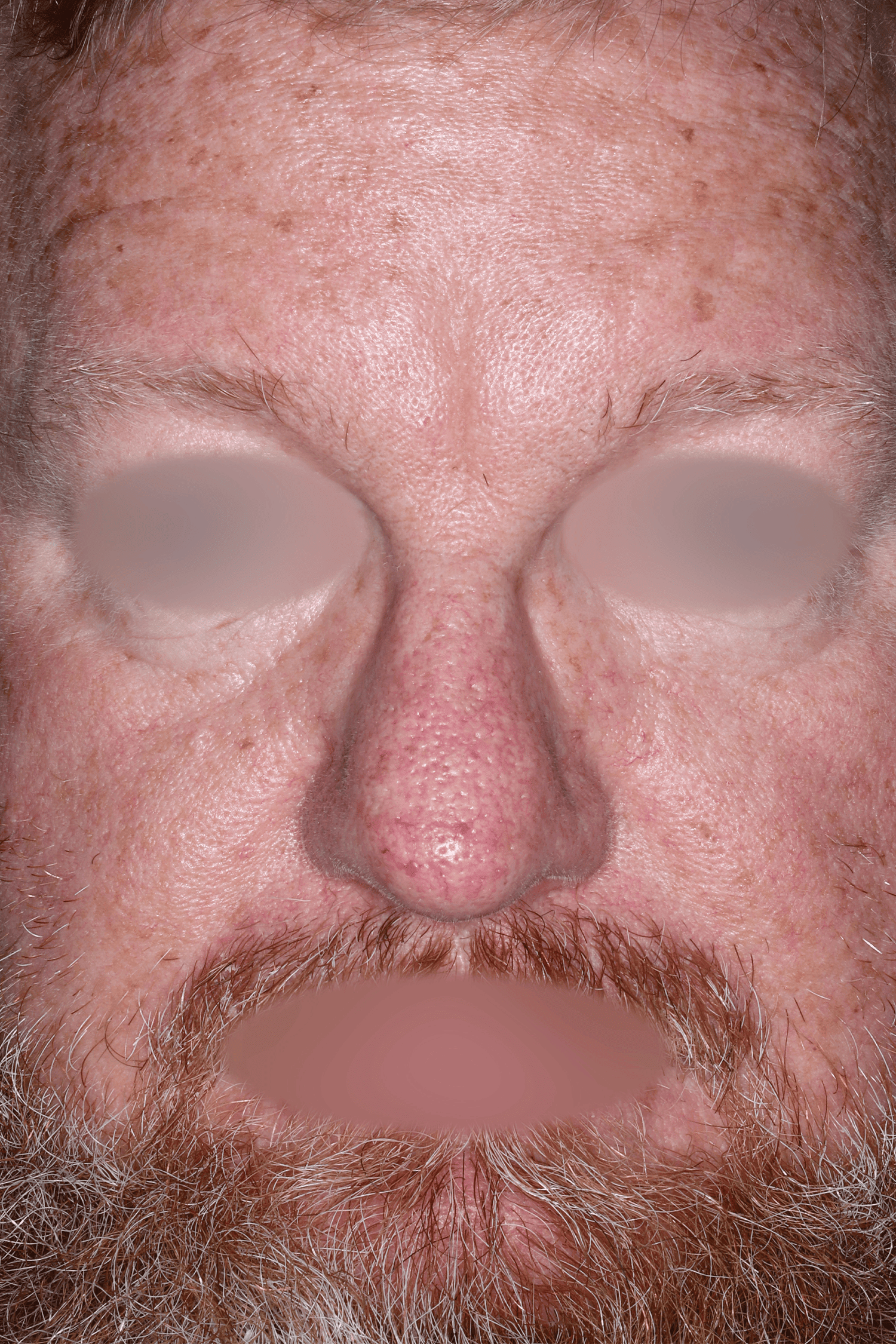 Patient D After