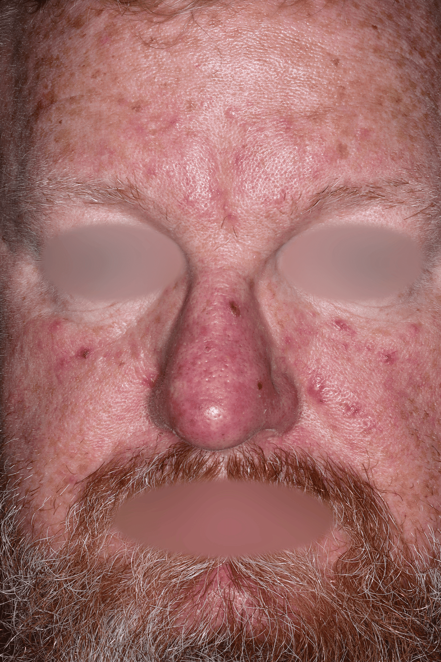Patient D Before
