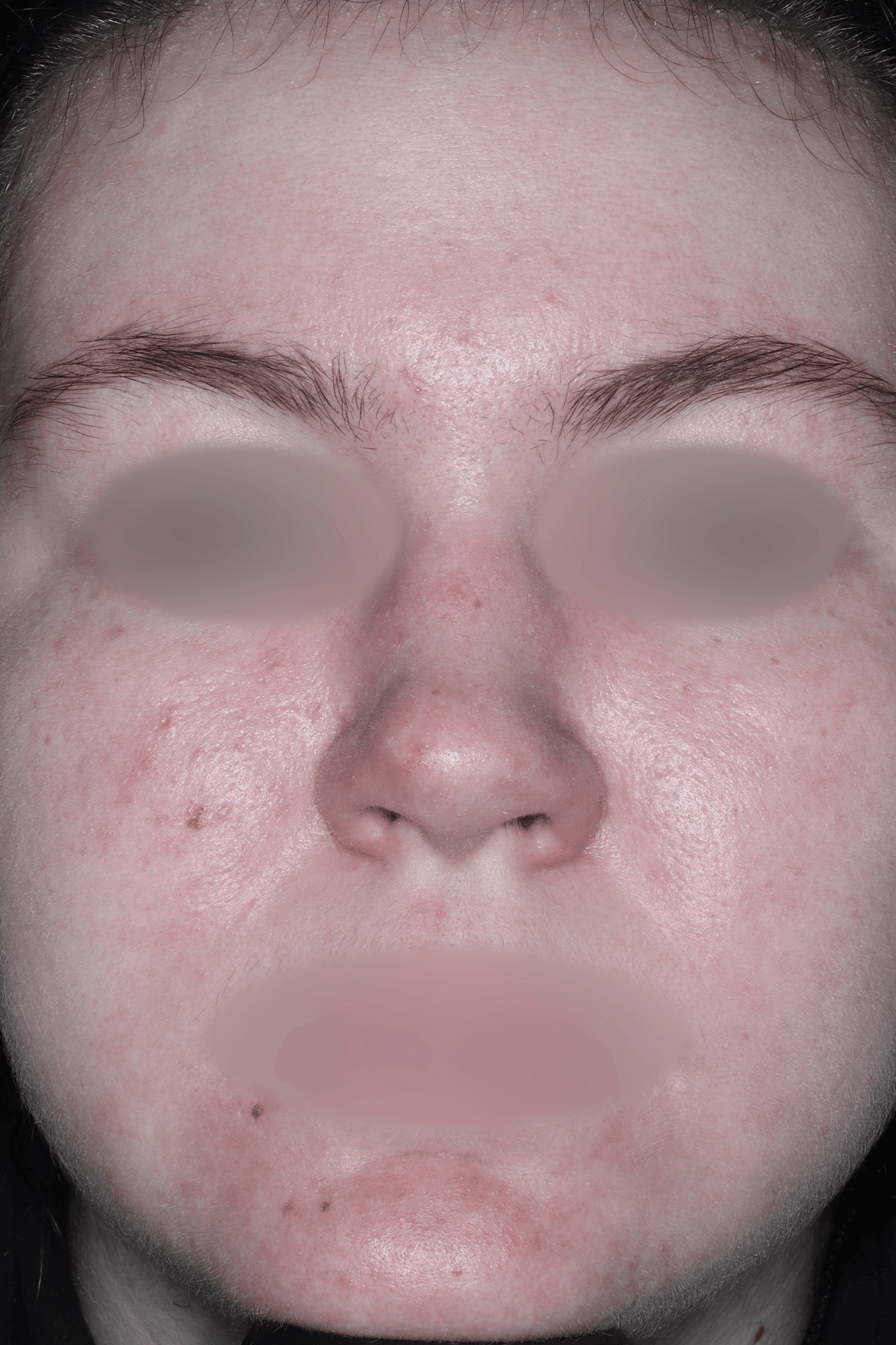 Patient E After